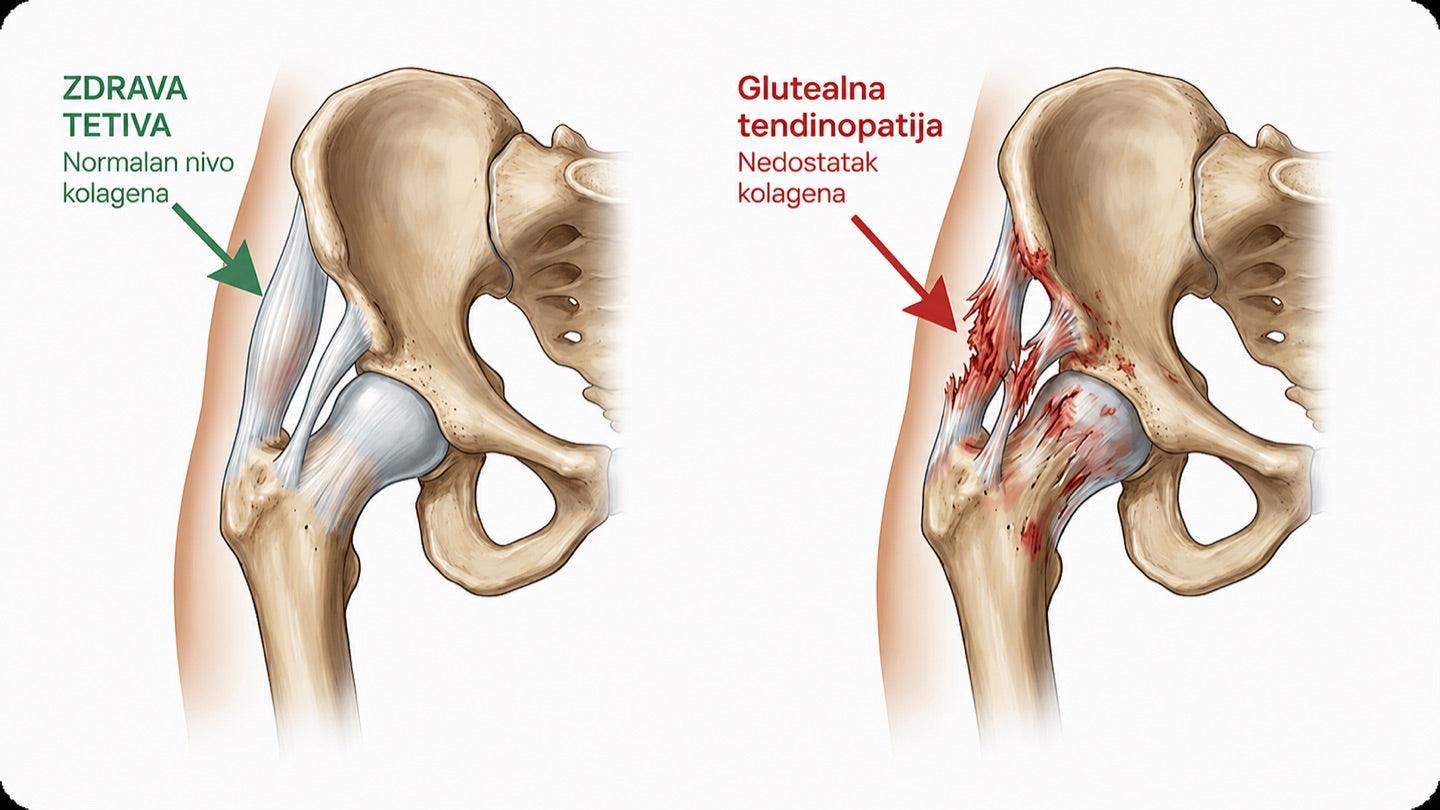 Zdrava tetiva i glutealna tendinopatija